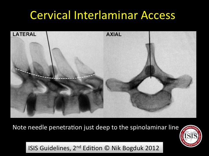will emg nerve test still work if on steriod for pain will emg nerve test still work if on steriod for pain