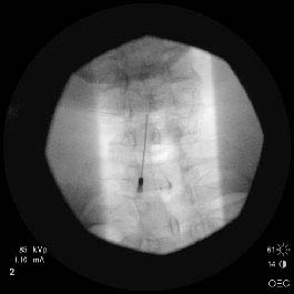 Cervical Epidural 1