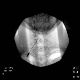 Cervical Epidural 2