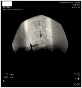 Cervical Facet