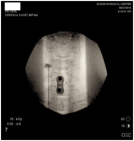 Cervical Facet