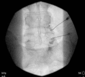 Lumbar Injection