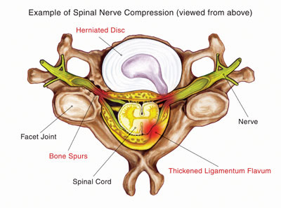 Cervical epidural steroid block