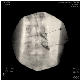 Nerve root epidural steroid injection