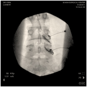 Lumbar epidural injection