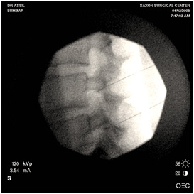 Lumbar epidural injection