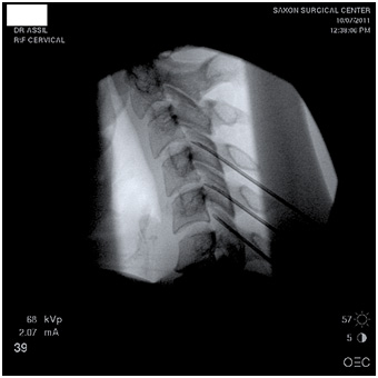 Lumbar RF neurotomy