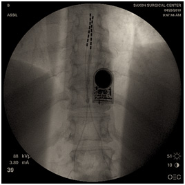 Thin leads implanted 1