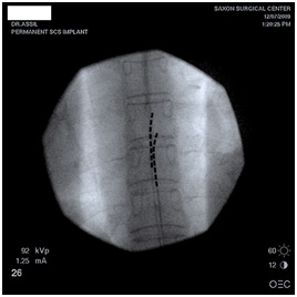 Thin leads implanted 2