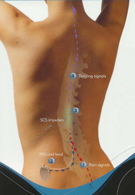 Spinal Cord Stimulator